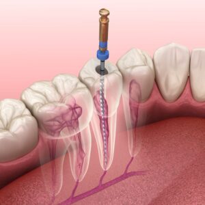 Illustration of instrument being used to perform root canal therapy